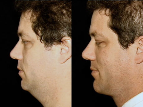 Neck & Jowl Liposuction case #37879