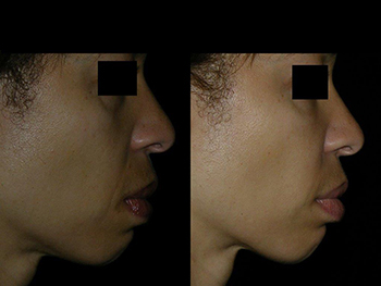 new44-yo-before-and-after-radiesse-juvederm-botox20101124113954270-20101214092012861