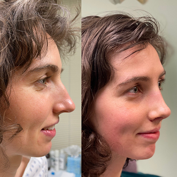 Rhinoplasty case #37572