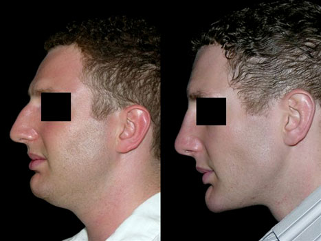 rhinoplasty_neck_lipectomy_chin_implant1