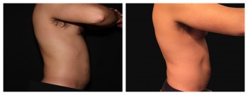 Coolsculpting case #37948