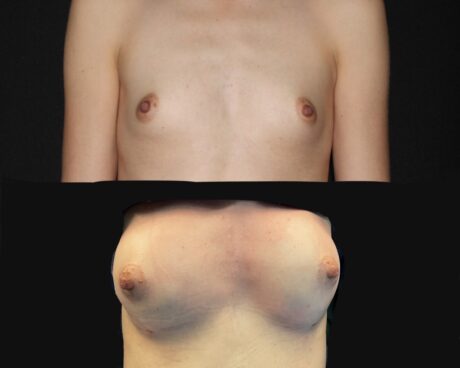 Breast Augmentation Fat Transfer case #37687