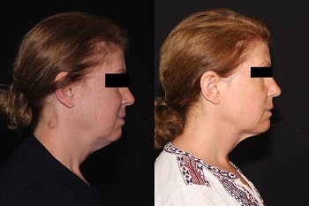 Kybella case #37638