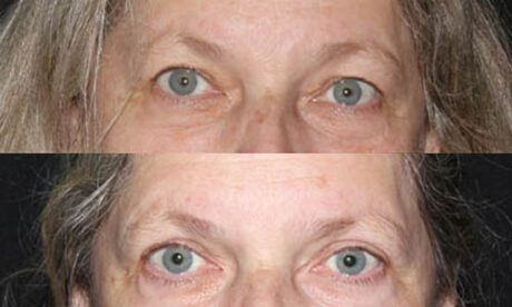 Blepharoplasty case #3454