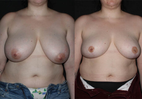 Breast Reduction case #38692